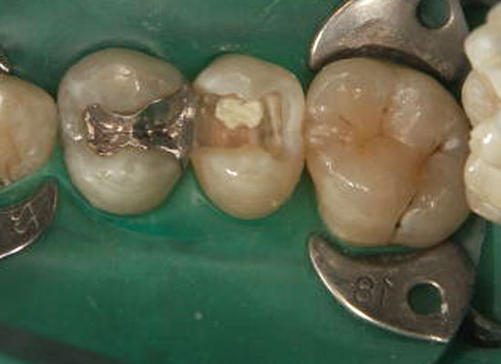 神経を抜かずにむし歯治療をした症例